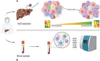 Inflammation-related prognostic markers in resected hepatocellular carcinoma